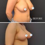 A high-resolution clinical comparative photograph showcasing a medical body transformation, presented in a split-screen format against a neutral dark grey studio backdrop. The top panel, labeled 'BEFORE', captures a female subject from a profile perspective, utilizing standard clinical lighting to document anatomical structure. The bottom panel, labeled '4 MONTHS', presents the post-procedural result under consistent, balanced studio lighting, emphasizing improved tissue projection and refined contouring. The photography quality is characteristic of professional DSLR standards, focusing on clarity and color accuracy for medical documentation. The subject is posed in a standing position, wearing simple, light-toned undergarments that do not obstruct the view of the chest and torso. The composition is clean and technical, designed for objective aesthetic evaluation, with subtle digital masking applied over the nipple areas for privacy, ensuring the focus remains on the surgical outcome and overall body silhouette.