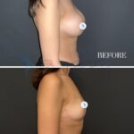 A split-screen medical comparison of a female torso from a profile perspective, displayed in high-definition clinical photography. The top frame, labeled 'BEFORE', captures a natural silhouette against a neutral, dark matte background. The bottom frame, labeled '6 MONTHS', shows the same subject post-procedure, maintaining consistent lighting and positioning. The lighting is clinical and uniform, emphasizing anatomical contours and surgical results without harsh shadows. The subject is captured in a neutral posture, highlighting the aesthetic transformation. The imagery serves a professional purpose, utilizing a sharp, DSLR-quality lens to ensure skin clarity and precise focus on the changes in the chest area, avoiding any dramatic or artistic distortion to maintain medical integrity. The background is a clean, non-distracting studio gray, ensuring the subject remains the sole focus of the editorial documentation.