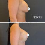 A professional clinical comparison diptych featuring high-resolution, sharp-focus DSLR photography of a female torso from a profile perspective. The image captures the post-surgical transformation with clinical precision, utilizing a neutral, uniform lighting setup that minimizes harsh shadows to accurately document anatomical contours. The lighting highlights the skin texture, showing a natural complexion with visible pores and subtle skin tone variations, indicative of a medical examination environment rather than high-fashion editorial. The subject is shown in a standing posture, emphasizing the change in breast volume and projection before and three days after surgery. The composition is clean and minimalist, set against a solid dark grey background, with white text overlays denoting 'BEFORE' and '3 DAYS'. The aesthetic is strictly documentary and medical, focusing on volumetric enhancement and surgical outcome precision.