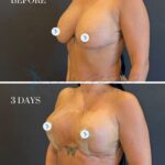 A split-screen medical comparison of a female patient's breast augmentation, captured with high-resolution DSLR photography likely utilizing a sharp 50mm or 85mm lens for clinical precision. The lighting is functional and even, designed to minimize shadows while clearly documenting skin texture, surgical markings in purple ink, and the placement of medical tape and nipple covers. The subject displays a neutral, upright clinical posture against a minimalist, matte dark-grey background. The image focuses on post-operative results at '3 DAYS' compared to the 'BEFORE' baseline, highlighting the changes in volume and contour. The skin tone is natural, showing realistic texture, pores, and subtle variations without artificial enhancement, prioritizing medical transparency and clarity over artistic editorial stylization. The composition is strictly utilitarian, intended to showcase the transformation of the chest area with academic rigor.