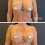 A clinical, split-screen medical comparison image showcasing a patient's chest before and three days after a surgical procedure. Captured with high-fidelity DSLR photography, the image utilizes even, studio-grade flat lighting that minimizes harsh shadows, ensuring clear visibility of skin texture and anatomical changes. The subject is female, captured in a neutral, forward-facing medical stance against a plain, dark grey background. In the 'Before' panel, the natural anatomy is visible; in the '3 Days' panel, surgical markings, thin translucent medical tape, and protective nipple covers are evident, highlighting the post-operative recovery phase. The overall composition is clean and professional, prioritizing clinical accuracy and diagnostic detail over artistic stylization, with the lighting design focused on revealing subtle variations in skin tone and the immediate post-surgical healing process.