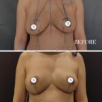 A clinical before-and-after comparison diptych documenting a breast surgery recovery. The top frame shows the pre-operative state with surgical markings drawn in black ink on a female torso against a neutral background. The bottom frame captures the post-operative result at six months, displaying improved breast contour, symmetry, and volume. The photography is professional, utilizing soft, clinical lighting that evenly illuminates the skin's natural texture and tone, free from excessive shadow or artificial glare. The focus is sharp, highlighting the precision of the medical outcome. The composition is clean and objective, designed for aesthetic medical documentation, with minimal distractions to ensure the viewer's attention remains solely on the anatomical transition.