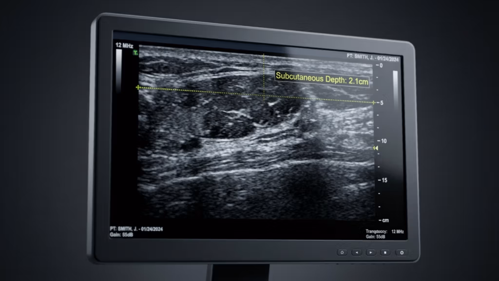 A high-resolution, photorealistic digital rendering of a medical ultrasound diagnostic monitor displaying a grayscale sonographic scan. The screen is framed in a matte black, industrial-grade bezel, set against a dark, neutral background that emphasizes the screen's luminescent interface. The ultrasound image shows internal tissue structure with a yellow measurement overlay indicating 'Subcutaneous Depth: 2.1cm'. The lighting is clinical and focused, mimicking professional medical imaging equipment, with crisp reflections on the screen's surface. The composition is clean and technical, capturing the sterile, precise atmosphere of a diagnostic environment. The image quality is akin to 4k studio photography, utilizing a sharp focal depth to highlight the data on the display while maintaining professional clarity.