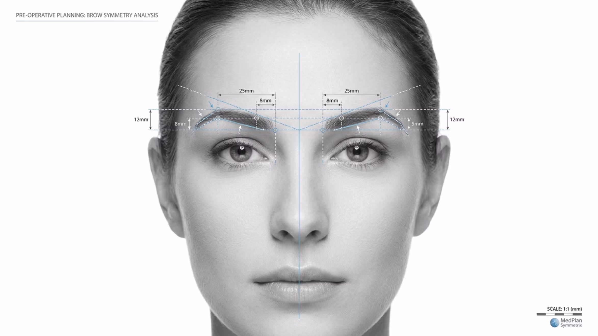 A clinical, high-resolution grayscale medical analysis image depicting a frontal portrait of a woman's face, utilized for 'Pre-operative Planning: Brow Symmetry Analysis'. Captured with precision-focused 85mm macro optics, the image features sharp, clinical clarity characteristic of professional high-end DSLR photography. The lighting is perfectly balanced, soft, and diffuse, eliminating harsh shadows to prioritize anatomical clarity and surface detail. The subject exhibits balanced facial proportions with a neutral, steady gaze. Her skin texture is rendered with smooth, uniform luminescence, emphasizing a clean, clinical aesthetic. Technical schematic overlays, including dotted guidelines, measurement markers (e.g., 25mm, 12mm, 8mm, 5mm), and directional arrows, are precisely mapped over the eyebrows to demonstrate surgical symmetry. The composition is strictly centered against a clean, white background, creating an atmosphere of professional medical precision, sterility, and advanced aesthetic planning. The MedPlan Symmetrix logo is visible in the bottom right corner.