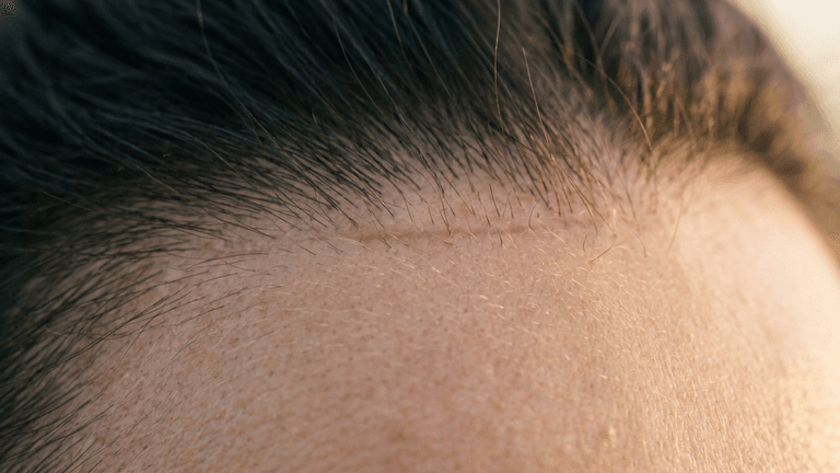 A hyper-detailed, extreme macro clinical-style close-up shot capturing a surgical scar line along the human hairline. Captured with a 100mm macro lens, the image displays exceptional 8K detail, highlighting individual hair follicles and the delicate, slightly raised texture of the post-procedural scar tissue. The lighting is soft and diffused, creating a neutral, clinical aesthetic that emphasizes natural skin pores and subtle luminescence on the dermis. The focus is strictly on the intersection of the skin and hair, rendering a clean, medical-editorial atmosphere with no clothing or background elements, prioritizing biological texture and surgical precision.