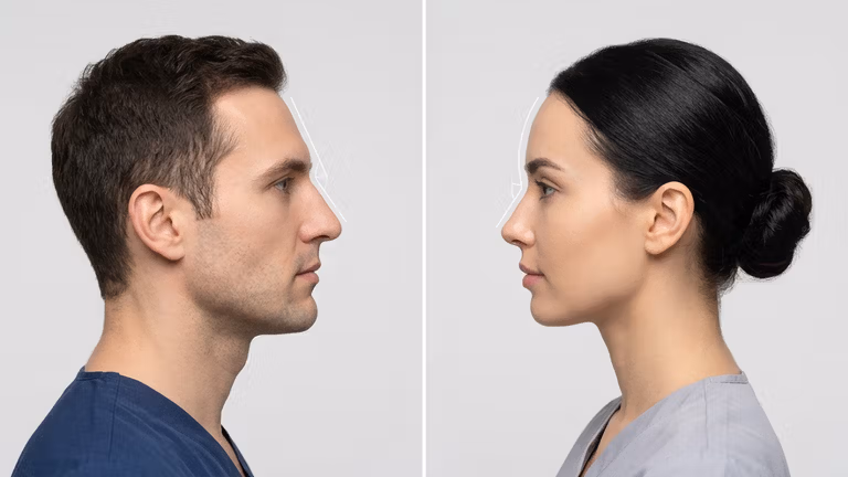Un ritratto clinico a schermo diviso, raffigurante un uomo e una donna di profilo, scattato con una fotocamera reflex digitale ad alta risoluzione e un obiettivo da ritratto da 85 mm. L'illuminazione è morbida e uniforme, tipica dell'estetica degli studi medici professionali, studiata per evidenziare i contorni e le caratteristiche anatomiche del viso senza ombre dure. Entrambi i soggetti presentano una pelle liscia e opaca ed espressioni neutre, conferendo un aspetto professionale e clinico. L'uomo indossa una maglietta blu scuro con scollo a V, mentre la donna una maglietta grigio chiaro, su uno sfondo grigio neutro, minimalista e uniforme. Sottili linee bianche sovrapposte delineano il dorso e il profilo del naso, enfatizzando l'aspetto anatomico dell'immagine. La composizione complessiva è sterile, equilibrata e molto precisa, a rispecchiare il contesto di una consultazione medica o estetica.