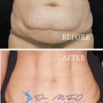 A professional, high-resolution 4K medical transformation comparative study captured with clinical precision, likely utilizing a sharp 50mm or 85mm macro lens to highlight structural skin changes. The lighting is clinical and uniform, utilizing soft-box studio illumination to eliminate harsh shadows, ensuring an objective, high-clarity presentation of the abdominal anatomy. The 'Before' panel reveals a female torso with significant laxity, skin redundancy, and subcutaneous adipose deposits in the infra-umbilical region. The 'After' panel showcases a dramatic aesthetic restoration, exhibiting a 'snatched,' toned abdominal contour with significantly tightened skin and restored surface smoothness. The skin texture appears hydrated and natural, free from artificial luminescence, focusing on authentic medical results. The subject is wearing neutral-toned undergarments in the top frame and a contrasting houndstooth-patterned textile in the bottom frame. The composition is a clean, split-screen vertical layout against a neutral dark background, designed for professional clinical portfolio display to showcase surgical efficacy.