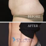 A clinical before-and-after comparison image displaying abdominal surgery results. The top panel, labeled 'BEFORE', features a close-up, high-resolution DSLR capture of a female torso against a plain background, showing natural skin texture and abdominal contours under flat, clinical lighting. The bottom panel, labeled 'AFTER', presents a profile view of the same area, captured with an 85mm macro lens to emphasize the refined, contoured silhouette of the midsection. The lighting here is more refined, casting subtle highlights that accentuate the 'snatched' waistline and smooth skin topography. The subject is wearing a dark, textured knit garment that provides a sharp visual contrast to the skin. The composition maintains a clean, professional aesthetic, common in medical photography, with a focus on surgical precision and dermatological clarity, free of excessive moisture or dramatic styling.