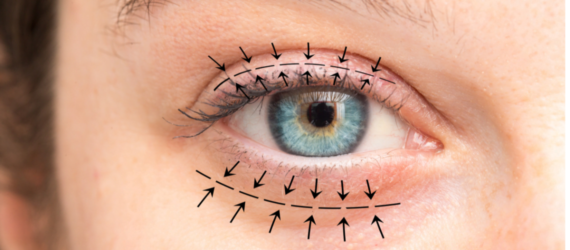 Was sind die Vorteile von Canthopexie?